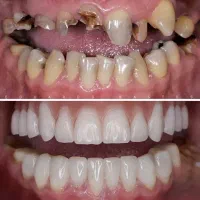 ایمپلنت ،ارتودنسی ،زیبایی با وام و اقساط ۱۵ ماهه|خدمات آرایشگری و زیبایی|آذرشهر, |دیوار