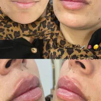 آموزش و تزریق ژل و بوتاکس