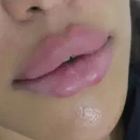 تزریق ژل و بوتاکس  و آموزش دارالرحمه شیراز|خدمات آرایشگری و زیبایی|شیراز, دارالرحمه|دیوار