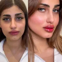 تزریق ژل،بوتاکس،فیلر،مزوتراپی،پی آر پی هایفو