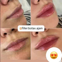 انجام ژل و بوتاکس با بهترین مواد اقساطی|خدمات آرایشگری و زیبایی|آزادشهر, |دیوار