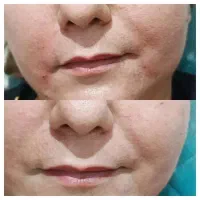 آف سه روزه کلیه خدمات ژل وبوتاکس وزیبایی