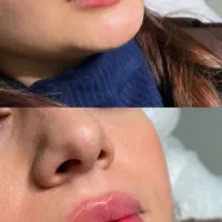 تخفیف ویژه ژل و بوتاکس