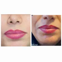 تزریق ژل و بوتاکس هیرفیلر و لیزر توسط پزشک|خدمات زیبایی و سلامت|تهران, طرشت|دیوار