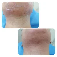 الکترولیز بانوان (رفع دائمی موهای زائد صورت و بدن)|خدمات آرایشگری و زیبایی|شیراز, گویم|دیوار