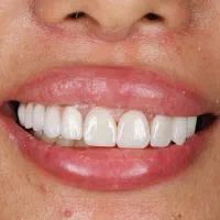 آف ویژه کامپوزیت سرامیکی