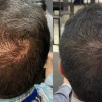 رفع ریشه ای ریزش مو (نمایندگی رسمی)