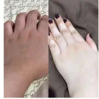 سفید کننده پوست