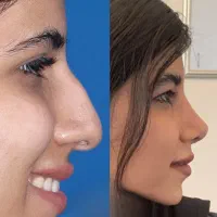 جراحی بینی توسط جراح ENT باسابقه با قیمت مناسب
