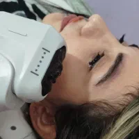 لیزر موهای زائد