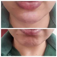 ژل و بوتاکس|خدمات آرایشگری و زیبایی|بم, |دیوار