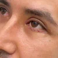 بلفاروپلاستی چشم بالاپایین/ غبغب/پره بینی