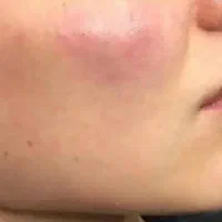 تخفیفات ژل.بوتاکس.فیلرلب روسی