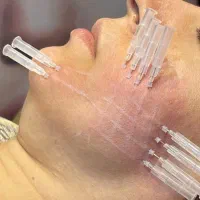 خدمات تخصصی امبدینگ (کاشت نخ جوانساز و لاغری)