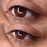 میکروبلیدینگ،شیدینگ،خط چشم،فیبروز