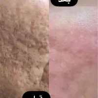 آغازجشنواره زیبایی پوست باهایفوتراپی وآراف فرکشنال