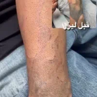 لیزر تتو ،ریمو،مربن تراپی ،خالبرداری|خدمات آرایشگری و زیبایی|شیراز, قصرالدشت|دیوار