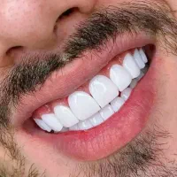 کامپوزیت دندان زیبایی