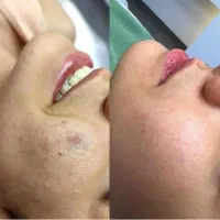 فیشیال و کربوکسی تراپی تخصصی پوست با تخفیفات ویژه