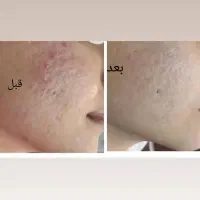 انجام‌ تمام خدمات فیلر و بوتاکس