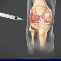 پی آر پی زانو رایگان برای محتوای پیج،فوری،فقط فردا