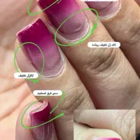 رفع اشکال تخصصی ناخن