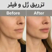 مدل فیلر لب شهربابک
