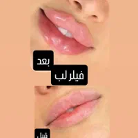 تزریق ژل وبوتاکس با بهترین قیمت در برازجان|خدمات آرایشگری و زیبایی|برازجان, |دیوار