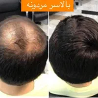 فروش و ترمیم پروتز مو طبیعی|خدمات آرایشگری و زیبایی|رشت, سعدی (تختی)|دیوار