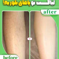 لیزر موهای زائد صورت وبدن  با دستگاه.تیتانیوم پلاس