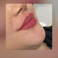 تزریق ژل وبوتاکس