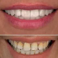 روکش.کامپوزیت.لمینت.عصب کشی