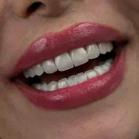 کامپوزیت دندان از دم قسط|خدمات آرایشگری و زیبایی|تهران, بلوار کشاورز|دیوار