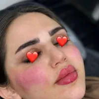 آف تزریق ژل وبوتاکس ومزومووصورت|خدمات آرایشگری و زیبایی|اهواز, نادری|دیوار