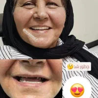 ایمپلنت کاشت دندان لمینت کامپوزیت ایمپلنت ۶۵۰۰|خدمات آرایشگری و زیبایی|تهران, ستارخان|دیوار