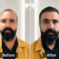 کاشت مو توسط تکنسین های شیراز با تخفیف ویژه|خدمات زیبایی و سلامت|کرمانشاه, |دیوار