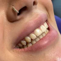 دندان کامپوزیت دندانپزشکی باهوش مصنوعی|خدمات آرایشگری و زیبایی|مشهد, دانشجو|دیوار