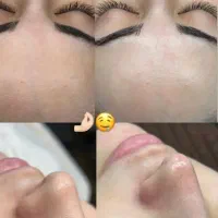 فیشال و پاکسازی تخصصی پوست ومو