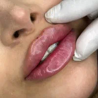 ژل بوتاکس 550