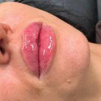 پی ارپی بوتاکس چانه هایفوفیلر لب چانه گونه لیفت نخ|خدمات آرایشگری و زیبایی|مشهد, هنرستان|دیوار