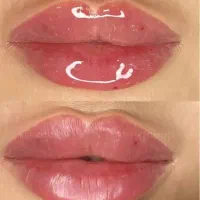 جشنواره تزریق ژل لب روسی،عروسکی،بوتاکس،جوانساز،مزو