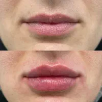 مدل فیلر فول فیس(فقط هزینه مصرفی)