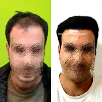 کلینیک تخصصی کاشت مو دکتر امیر رضا درخشان