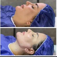 مرکزلیپوساکشن و ساکشن غبغب و زاویه سازی توسط جراح|خدمات آرایشگری و زیبایی|مشهد, سناباد|دیوار