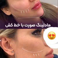 تزریق ژل 390بوتاکس رفع گودی سیاهی زیر چشم لیزر خال|خدمات آرایشگری و زیبایی|تهران, صادقیه|دیوار