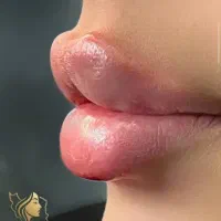 تزریق ژل وفیلر بادی و نخ و لیزر با دستگاه الکس۲۰۲۳|خدمات آرایشگری و زیبایی|تهران, تهرانپارس غربی|دیوار