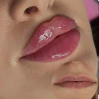 جشنواره زمستانه  لیزر (رایگان )تزریق ژل،بوتاکس