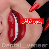 دندانپزشکی کامپوزیت ایمپلنت لمینت  (بدون تراش)