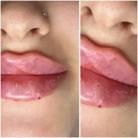 جشنواره تزریق فیلر مدت محدود فقط ۷۸۰ تومن|خدمات آرایشگری و زیبایی|زنجان, |دیوار