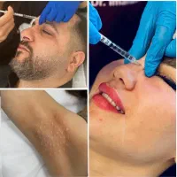 بوتاکس کل صورت ( پیشانی ، زیربغل ، کف دست و پا )